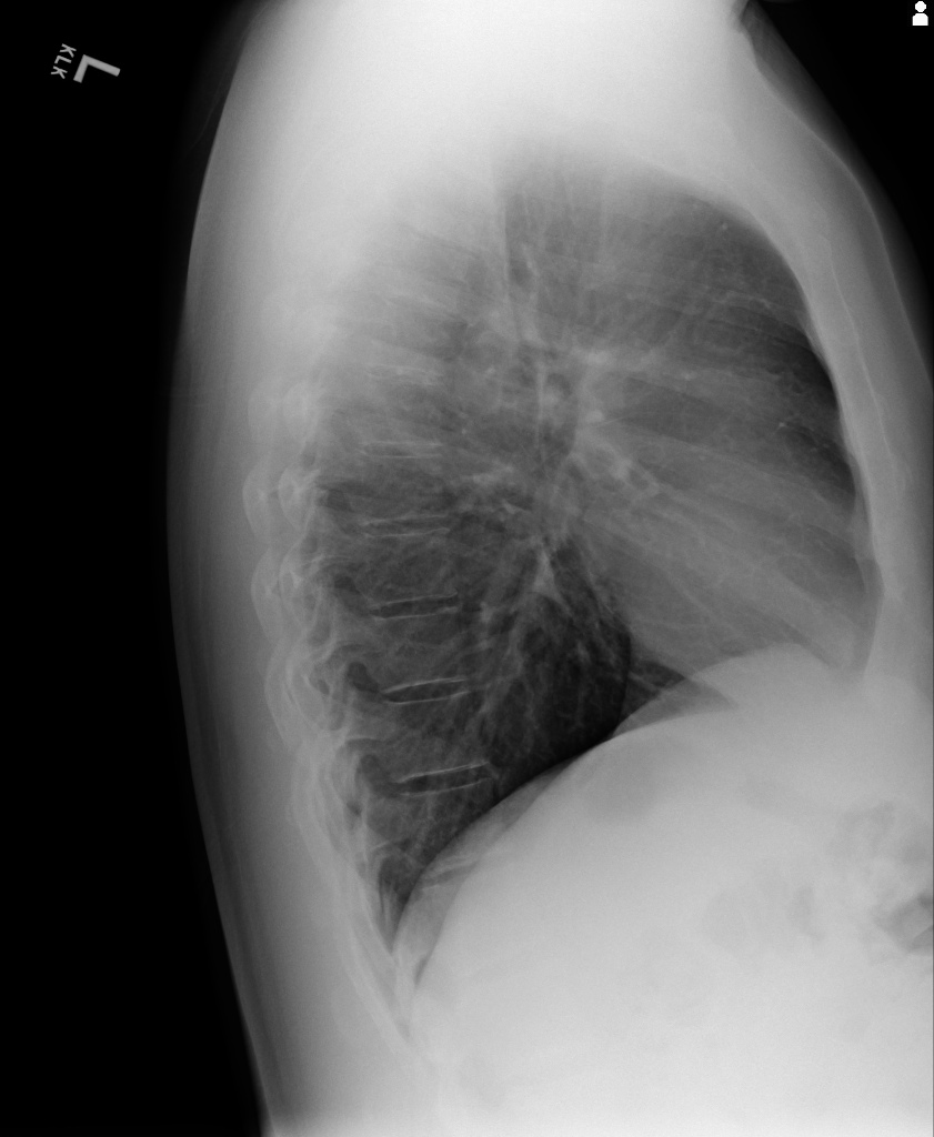 Normal Chest Xray Image Lateral - Image | Radiopaedia.org, Limb amputation alters body image and changes the client's adls, work, and recreational activities, which triggers a grieving process for the client.