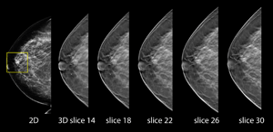 3D Tomosynthesis "slices"