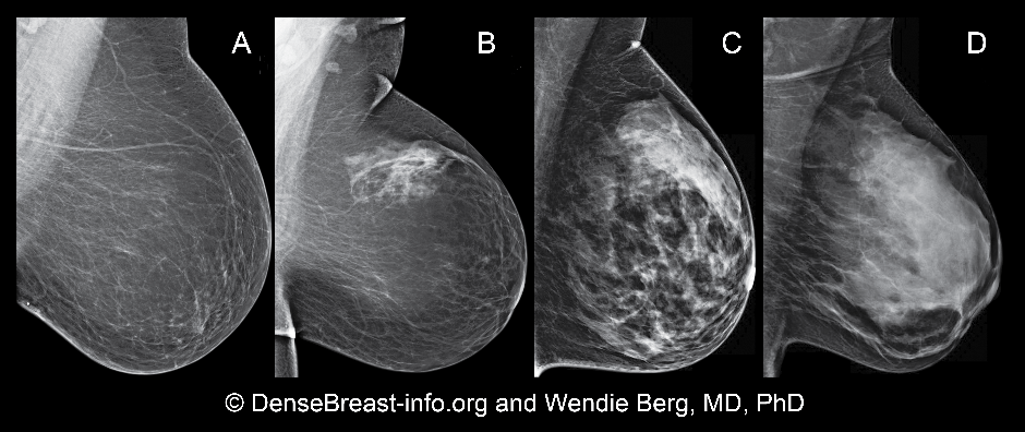 5 Things You Must Know About Dense Breasts Before Your Mammogram